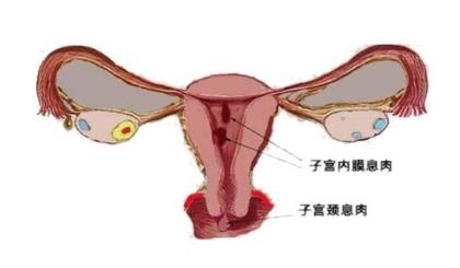 女性患有宫颈息肉有什么危害？
